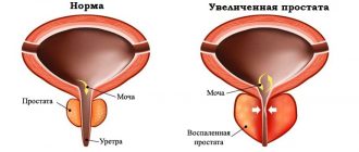 Scheme of a normal and enlarged prostate