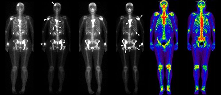 Сцинтиграфическая картина метастатического поражения костей скелета